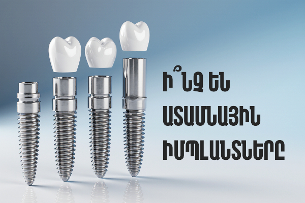ատամնային իմպլանտ