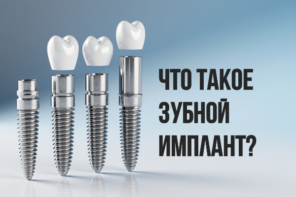 зубной имплант