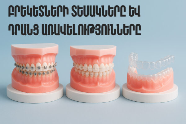բրեկետներ