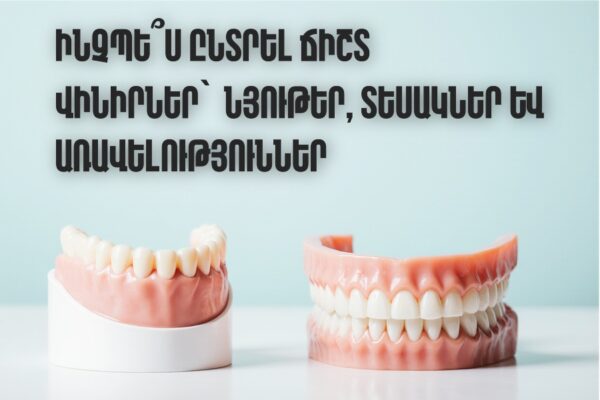 վինիրներ