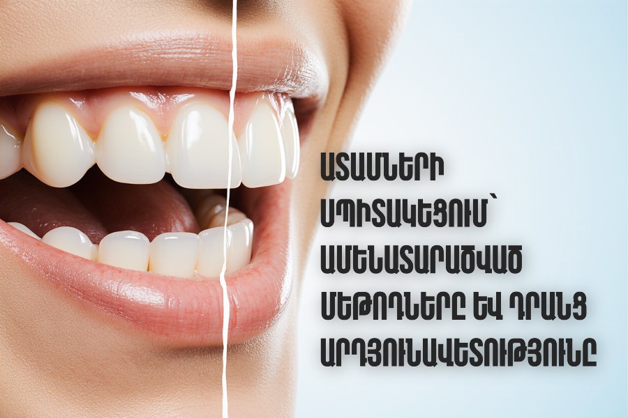 ատամների սպիտակեցում